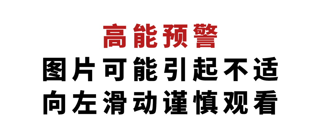 什么是vsd负压引流负压封闭引流术（VSD）：溃疡皮肤重生的福音_https://www.jmylbn.com_新闻资讯_第2张