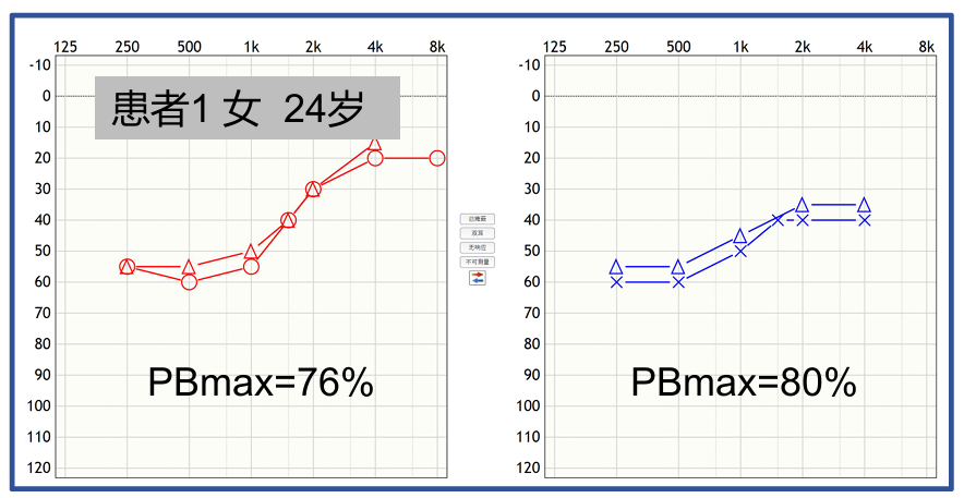 听力计怎么使用第十二期助听器验配师沙龙｜言语测听以及在助听器验配的应用_https://www.jmylbn.com_新闻资讯_第45张