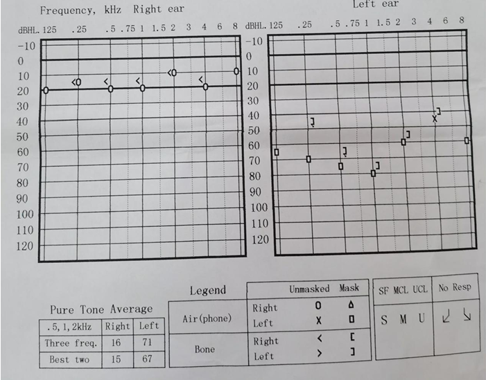 听力计怎么使用第十二期助听器验配师沙龙｜言语测听以及在助听器验配的应用_https://www.jmylbn.com_新闻资讯_第49张