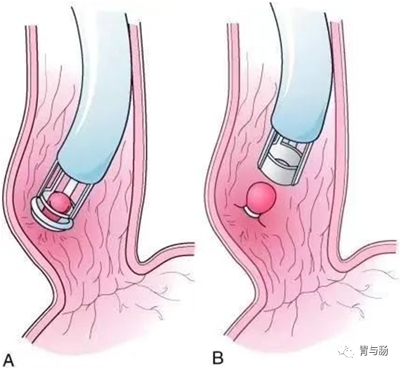 痔疮套扎吻合器怎么用消化内镜新技术--内镜下痔疮套扎术_https://www.jmylbn.com_新闻资讯_第3张