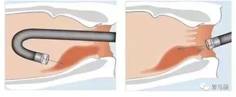 痔疮套扎吻合器怎么用消化内镜新技术--内镜下痔疮套扎术_https://www.jmylbn.com_新闻资讯_第4张