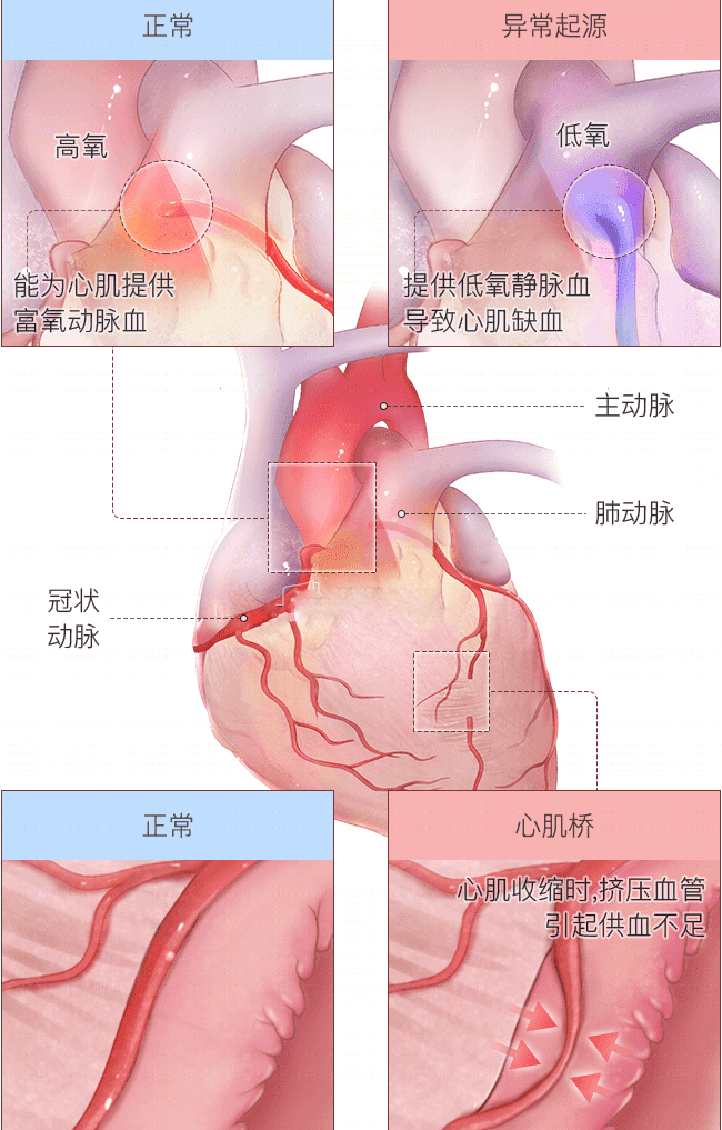 如何处理心绞痛？救治措施全解析！