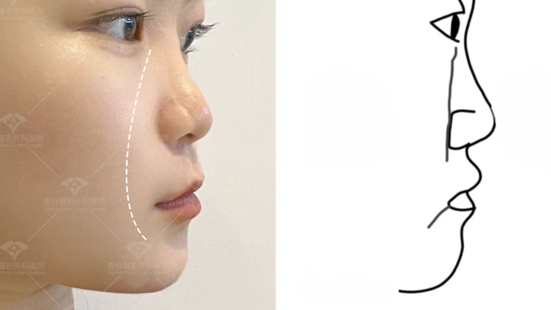 再凹的側臉也能變神顏——杏林改臉型