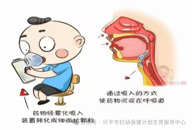 咬嘴雾化怎么做家长必看！儿科雾化治疗超实用指南_https://www.jmylbn.com_新闻资讯_第8张
