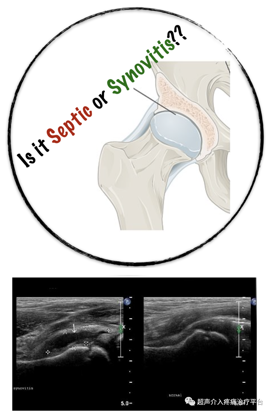髋关节疼痛常见原因（3）：髋关节滑膜炎