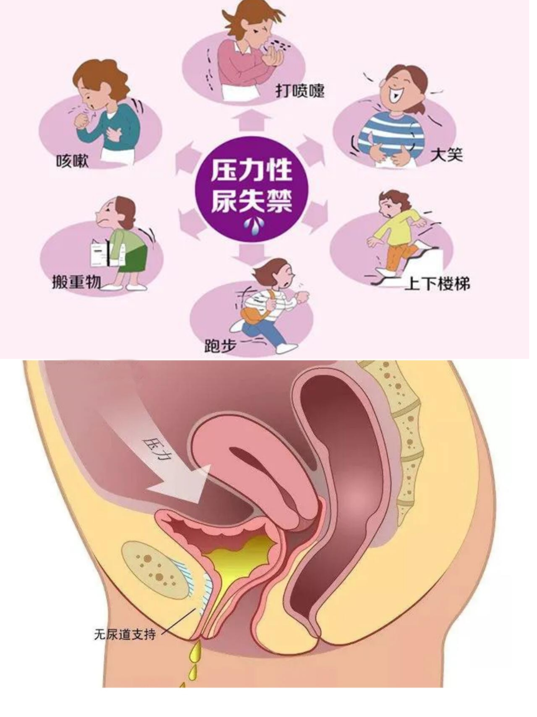尿道张力过强怎么办国考晋位升级之一科一报道｜呼和浩特市第一医院泌尿外科新技术分享——经阴道尿道无张力悬吊术（TVT）_https://www.jmylbn.com_新闻资讯_第4张