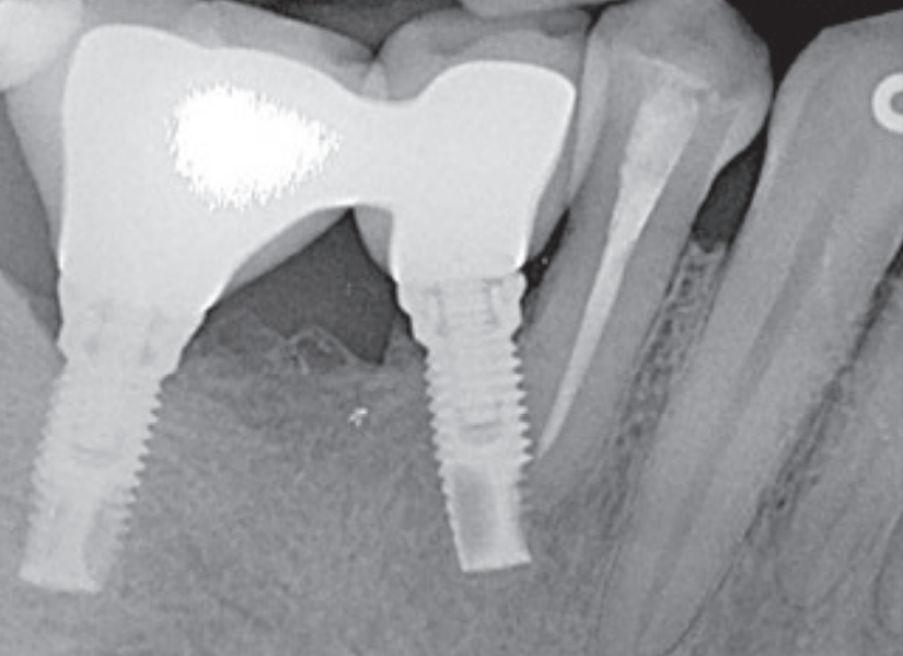 植体直接干到邻牙！怎么办？这个处理非常好！学习！