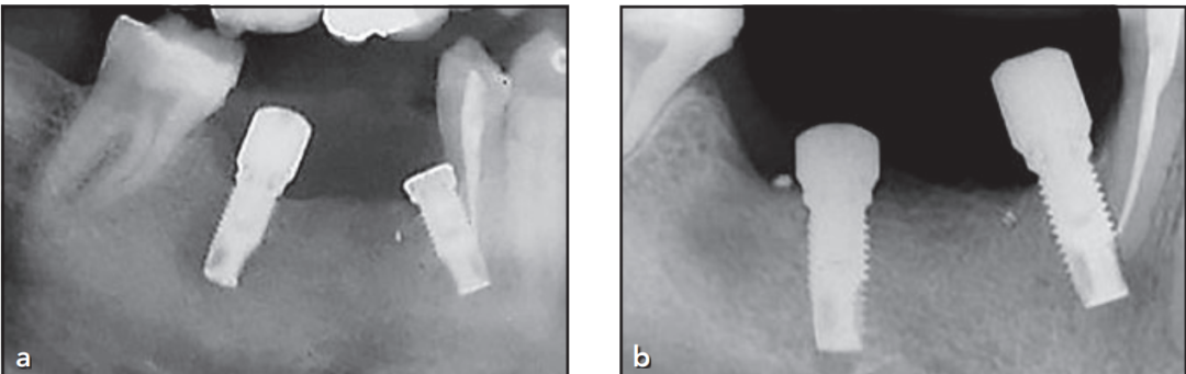 植体直接干到邻牙！怎么办？这个处理非常好！学习！