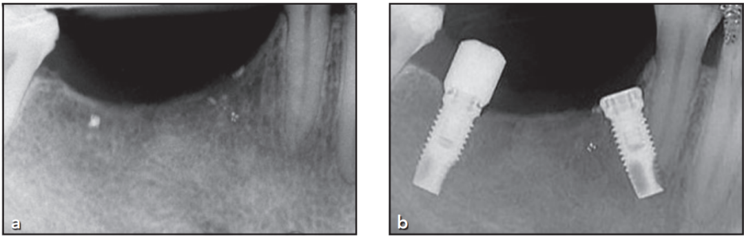 植体直接干到邻牙！怎么办？这个处理非常好！学习！