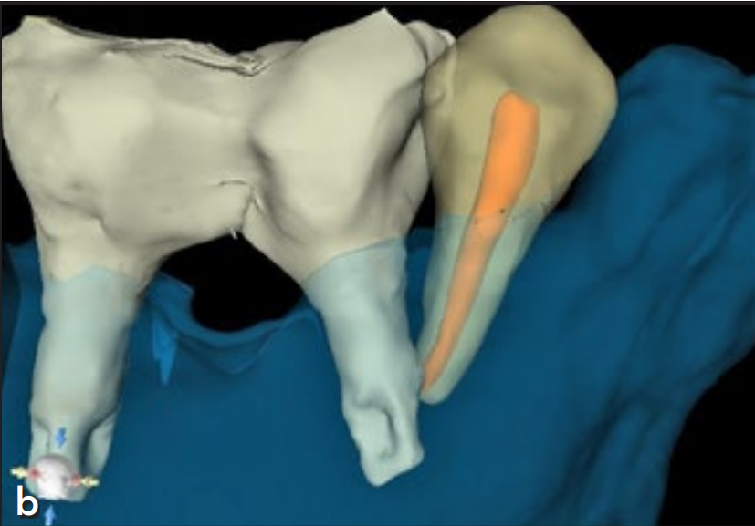 植体直接干到邻牙！怎么办？这个处理非常好！学习！