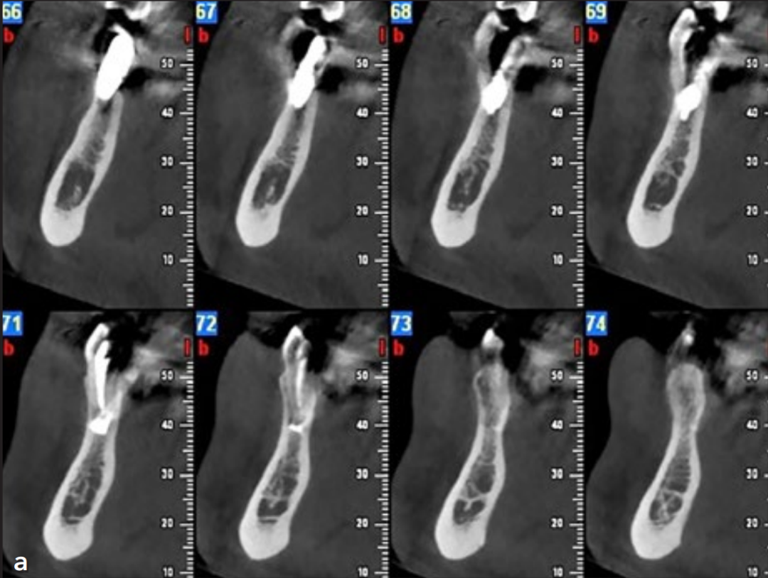 植体直接干到邻牙！怎么办？这个处理非常好！学习！