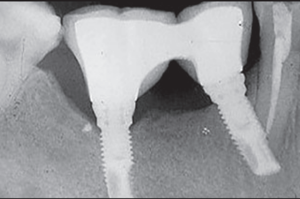 植体直接干到邻牙！怎么办？这个处理非常好！学习！