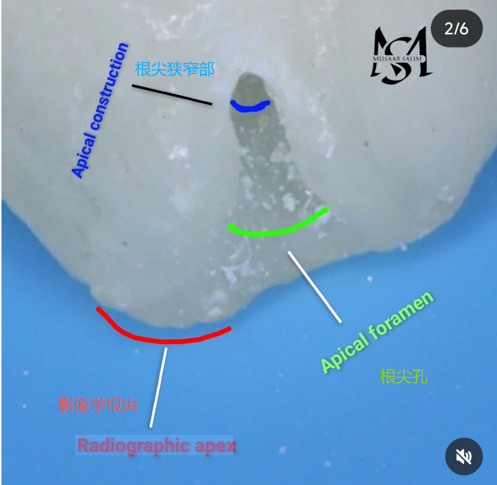 根测仪测完后，为什么要退0.5-1mm，图片解析很清楚