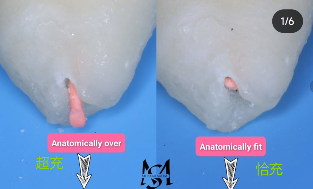 根测仪测完后，为什么要退0.5-1mm，图片解析很清楚