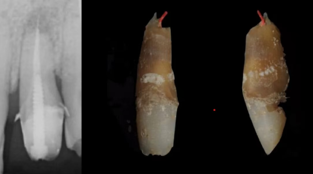 根测仪测完后，为什么要退0.5-1mm，图片解析很清楚