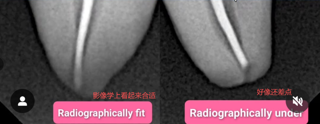 根测仪测完后，为什么要退0.5-1mm，图片解析很清楚