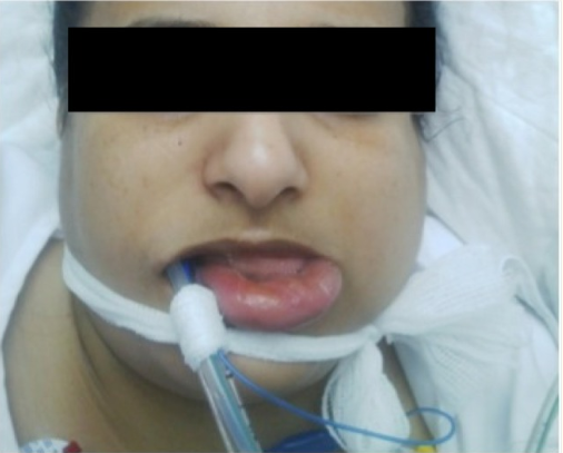 根管治疗，竟然转去ICU，原因在这！可能你也在用