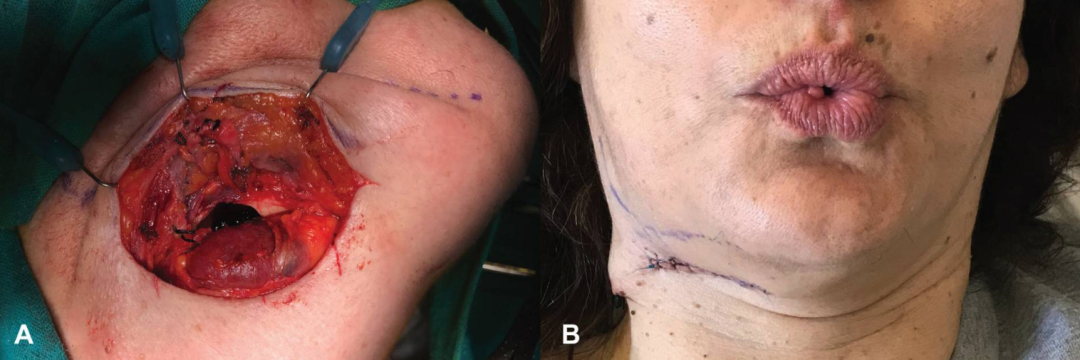 阻生智齿！从下颌缘入路进行拔除！值得一看