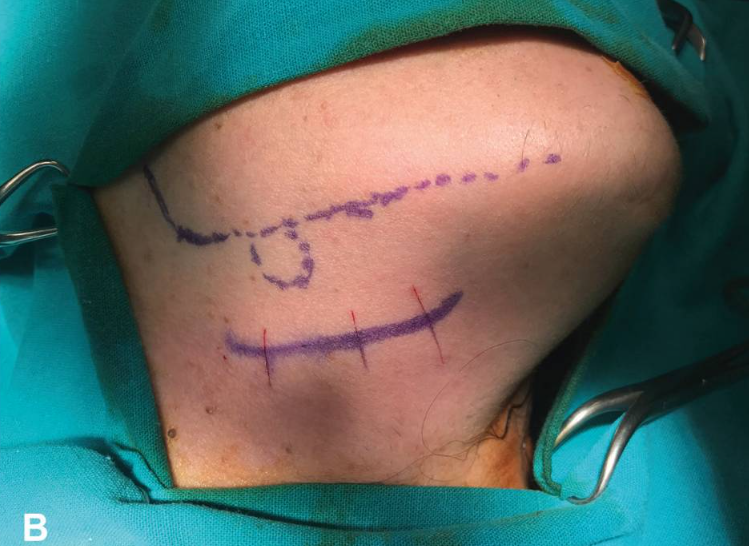 阻生智齿！从下颌缘入路进行拔除！值得一看