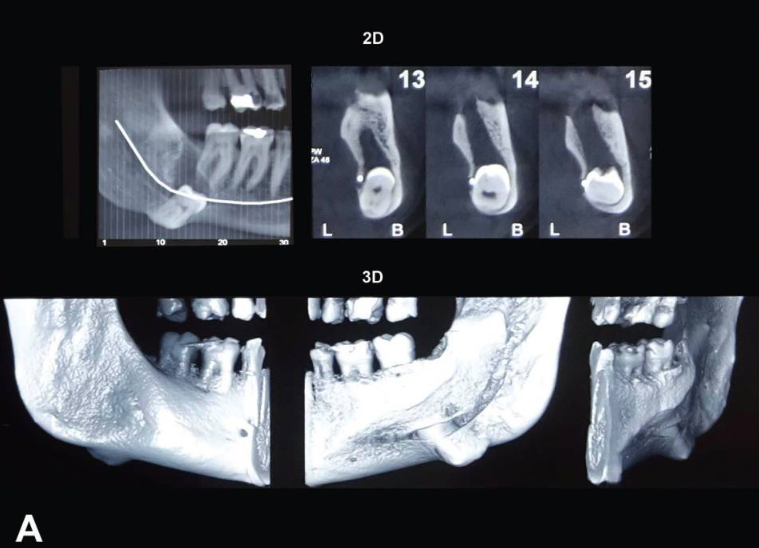 阻生智齿！从下颌缘入路进行拔除！值得一看