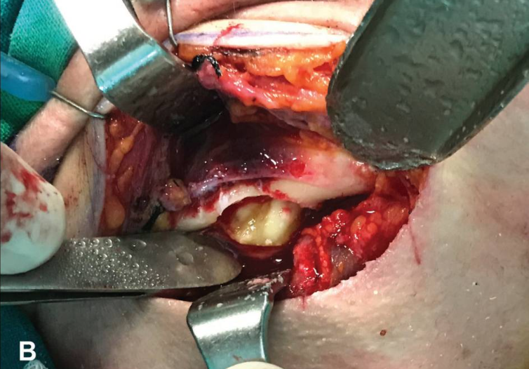 阻生智齿！从下颌缘入路进行拔除！值得一看