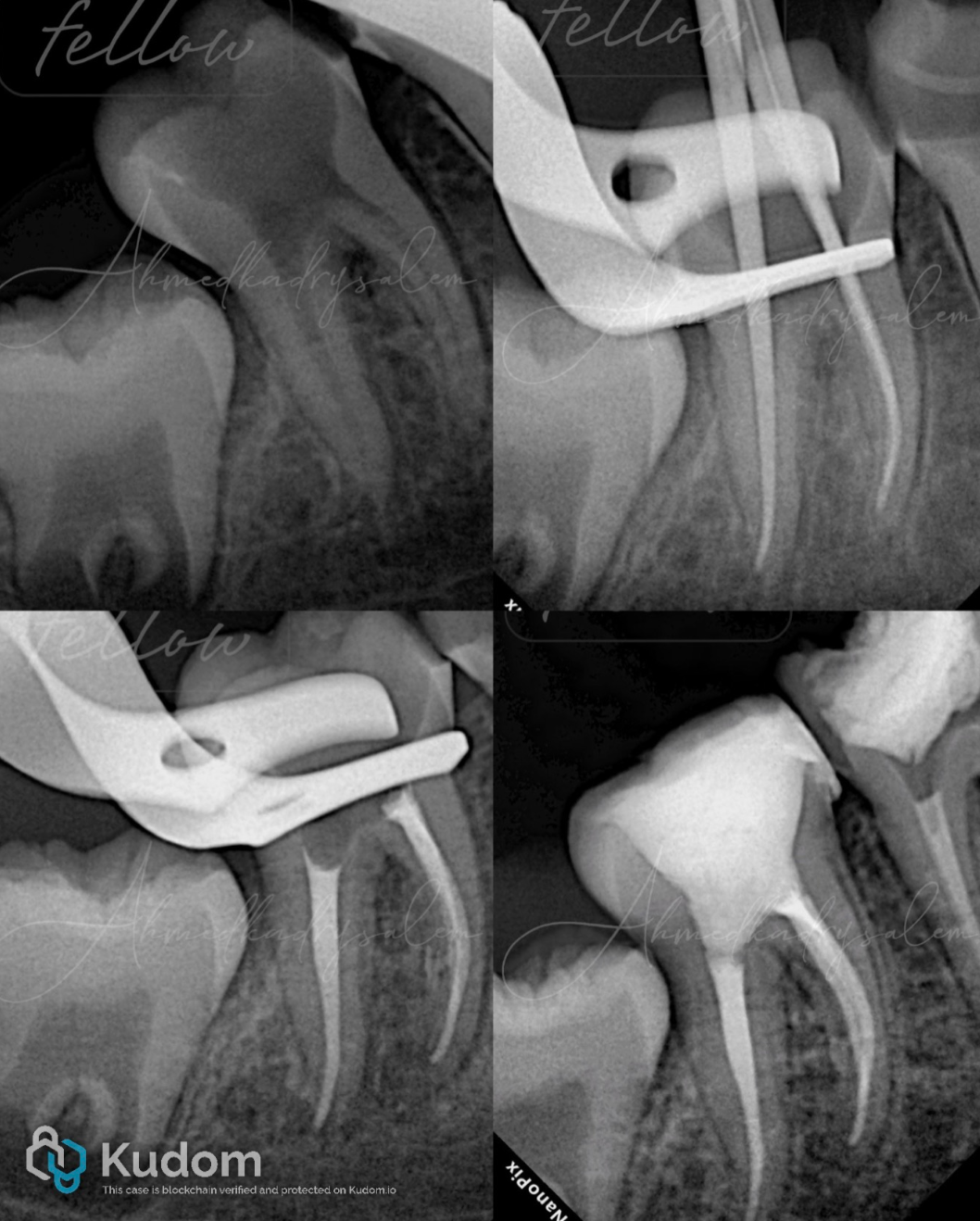 次氯酸钠在根管治疗到底怎么用？这篇文章指导性很强