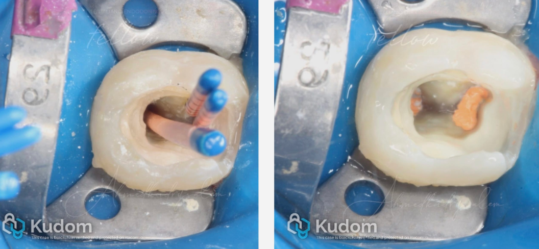 次氯酸钠在根管治疗到底怎么用？这篇文章指导性很强