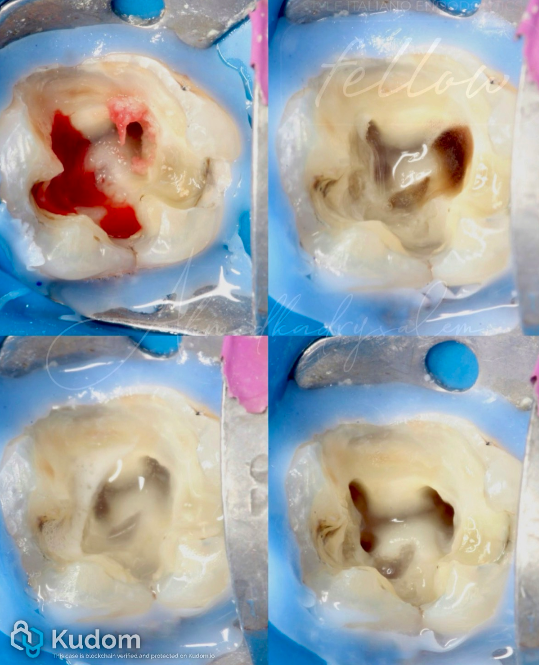 次氯酸钠在根管治疗到底怎么用？这篇文章指导性很强