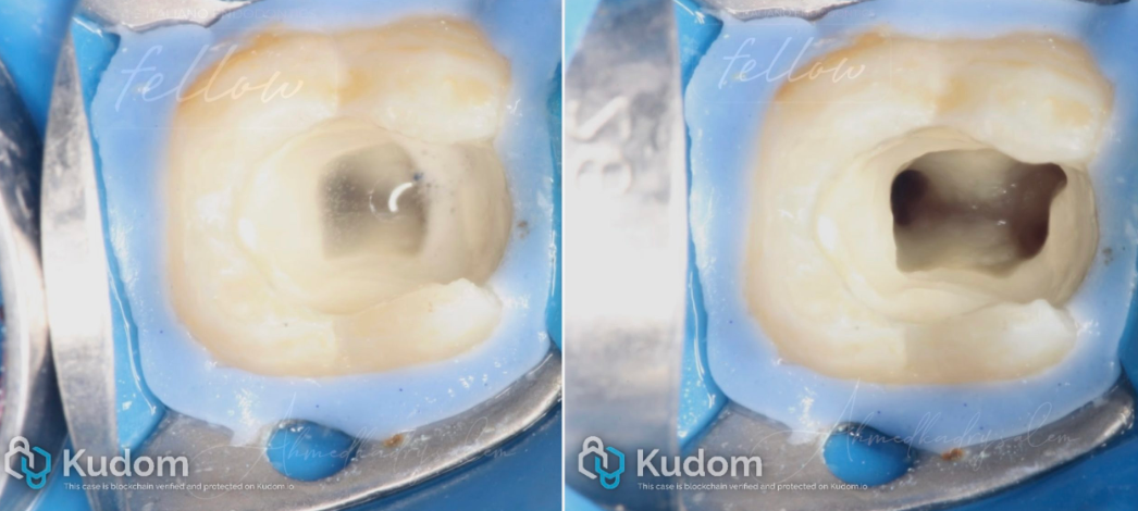 次氯酸钠在根管治疗到底怎么用？这篇文章指导性很强