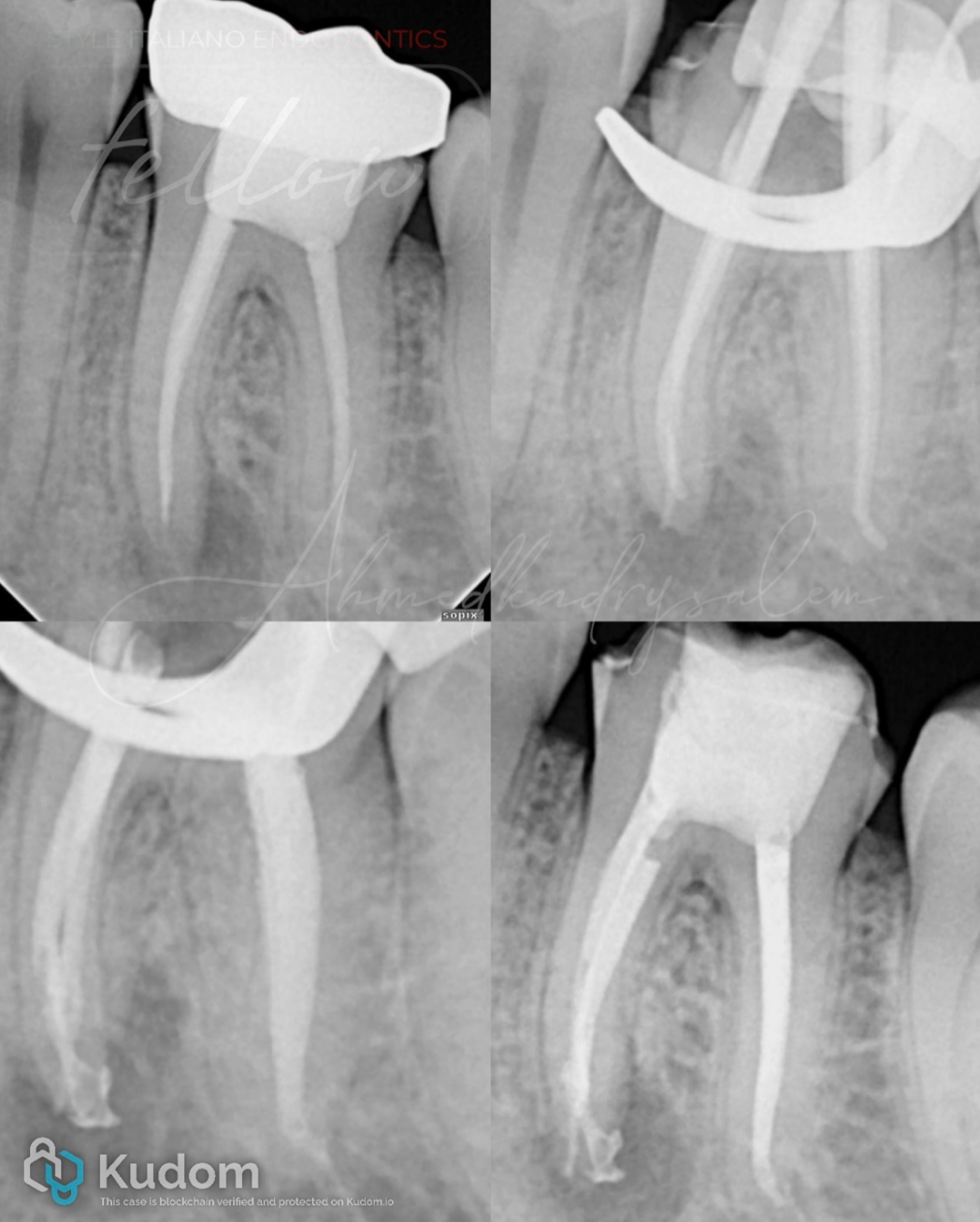 次氯酸钠在根管治疗到底怎么用？这篇文章指导性很强