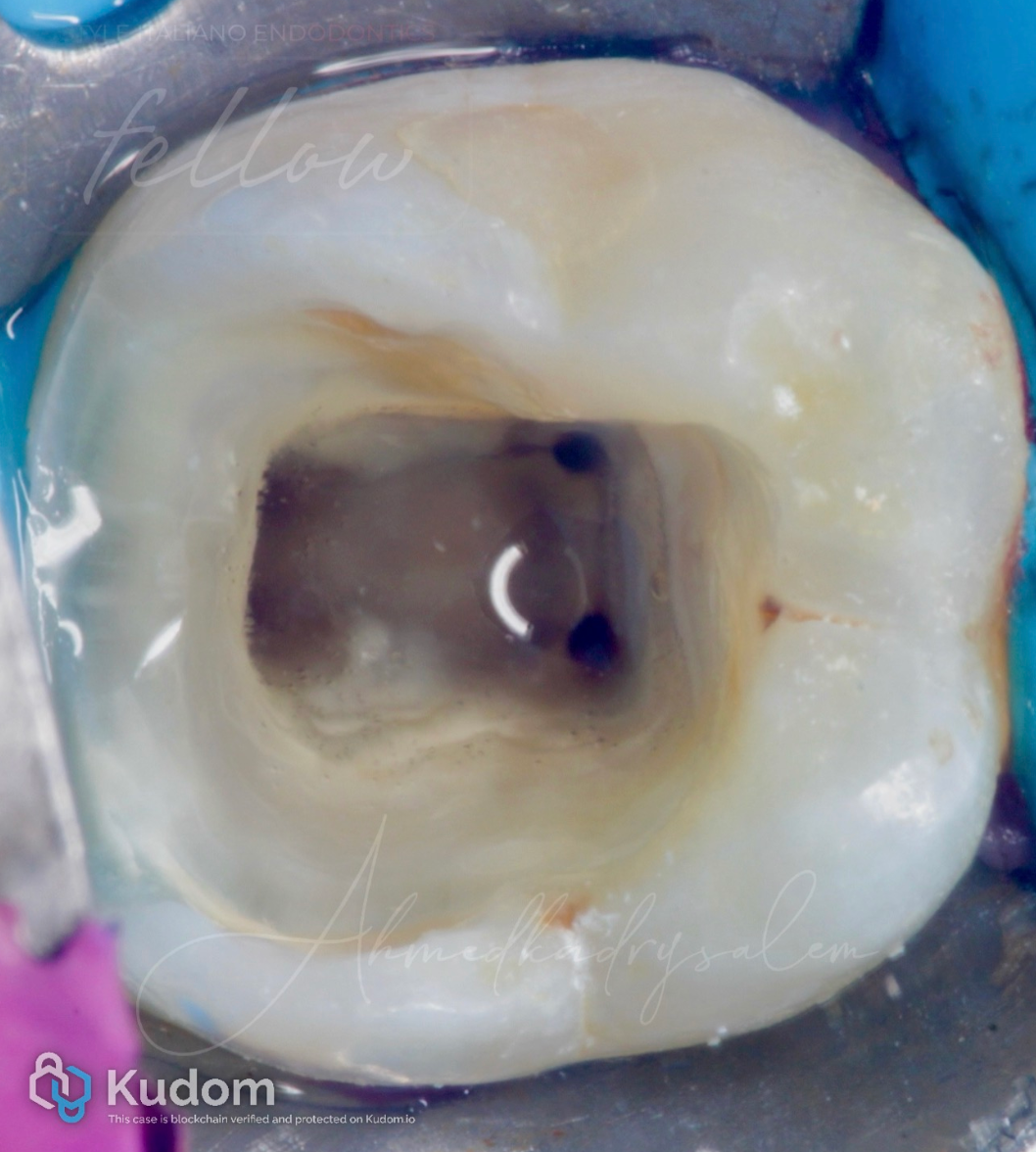 次氯酸钠在根管治疗到底怎么用？这篇文章指导性很强