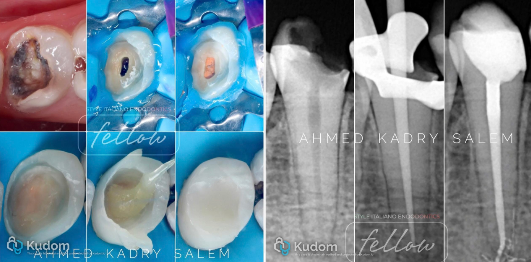次氯酸钠在根管治疗到底怎么用？这篇文章指导性很强