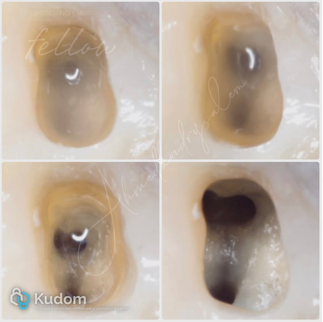 次氯酸钠在根管治疗到底怎么用？这篇文章指导性很强