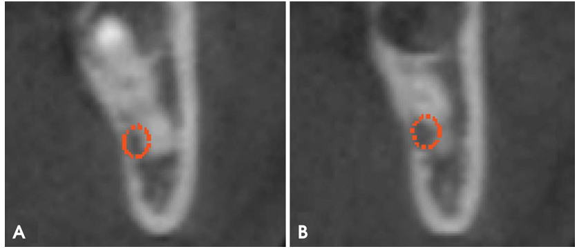 智齿已经压迫了神经，用这个方法拔，很安全