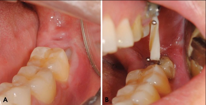 智齿已经压迫了神经，用这个方法拔，很安全