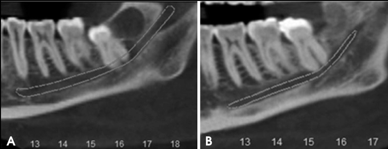 智齿已经压迫了神经，用这个方法拔，很安全