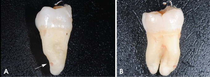 智齿已经压迫了神经，用这个方法拔，很安全