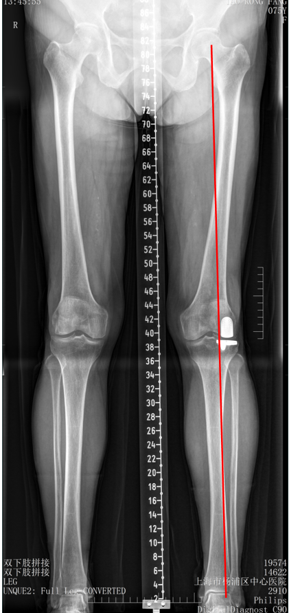【读懂单髁】从读懂X-ray开始：固定平台单髁假体(LINK®
