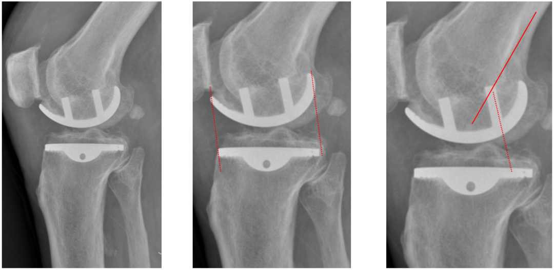 【读懂单髁】从读懂X-ray开始：固定平台单髁假体(LINK®