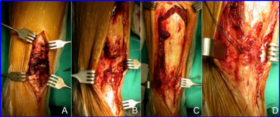​图文并茂：慢性跟腱断裂的最新治疗进展