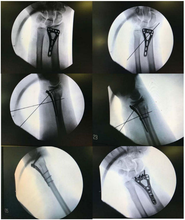 一文掌握，桡骨远端骨折微创钢板接骨术（MIPO），功能与美学效果双达标的安全技术！