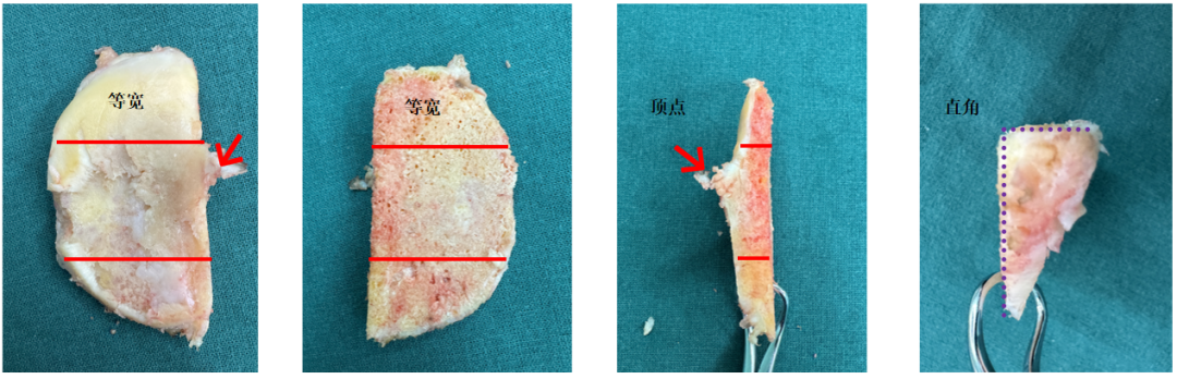 【读懂单髁】从读懂X-ray开始：胫骨假体位置解读