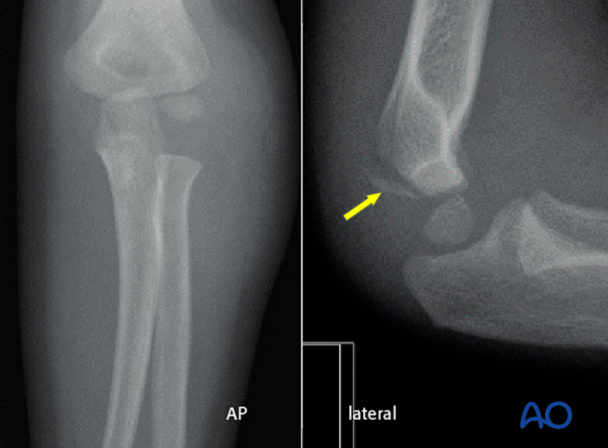 儿童肱骨外髁骨折的诊疗，本文全面总结！