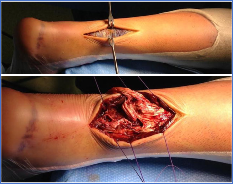 【手术技术】切开修复技术治疗急性跟腱断裂