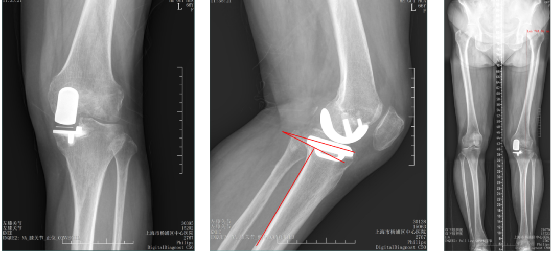 【读懂单髁】从读懂X-ray开始：胫骨假体位置解读