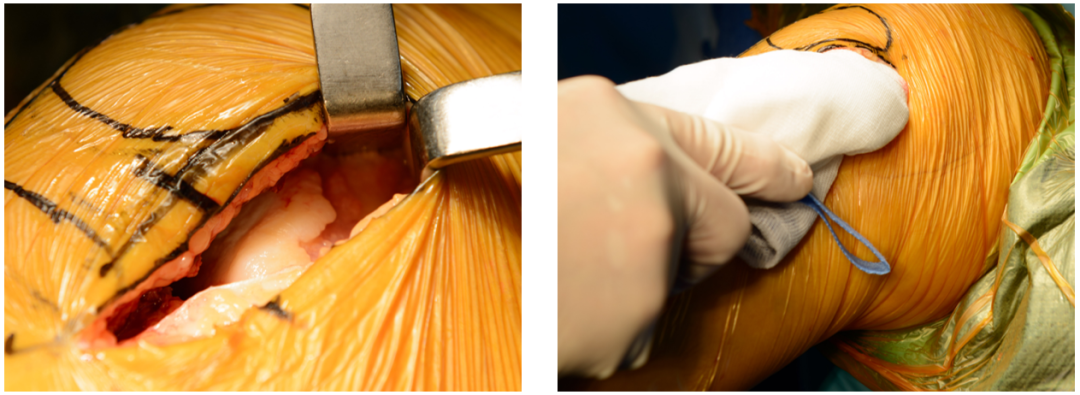 【滑动垫片单髁置换技术精讲系列】第一讲：麻醉、体位