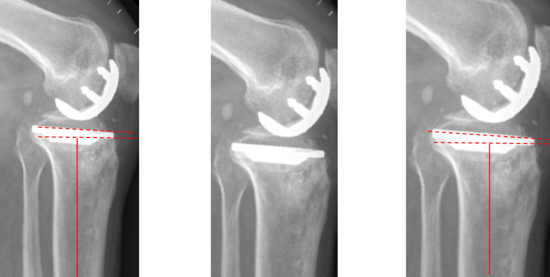 【读懂单髁】从读懂X-ray开始：固定平台单髁假体(SIGMA®