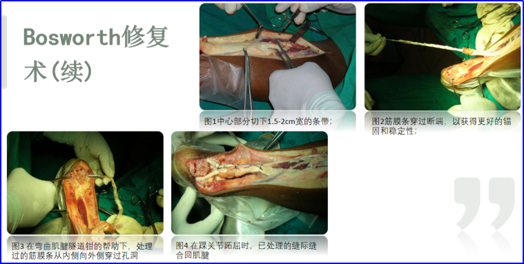 ​图文并茂：慢性跟腱断裂的最新治疗进展