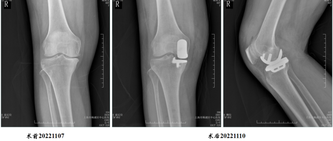 【读懂单髁】从读懂X-ray开始：胫骨假体位置解读