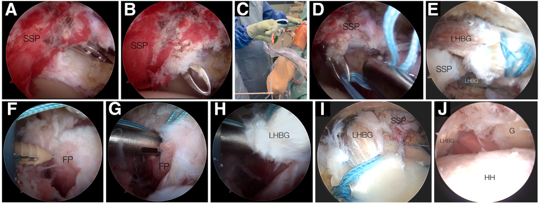 Hosentraeger技术：使用肱二头肌长头腱的关节镜下腱-腱置入术治疗不可修复肩袖撕裂